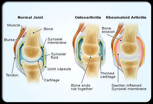 Joint Pain & Mobility